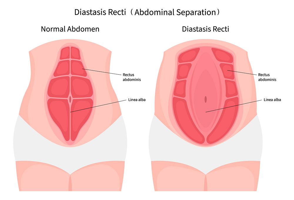 Diastasis recti repair, abdominal separation, rectus diastasis, abdominal wall weakness